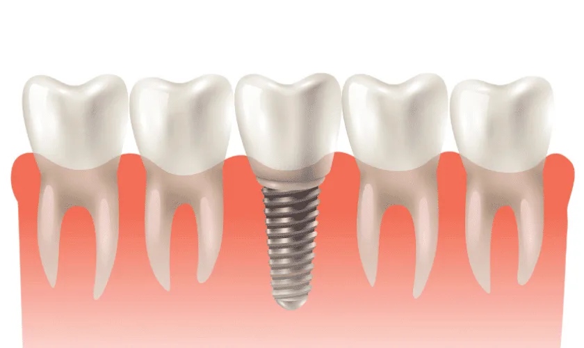Benefits of Choosing Dental Implants Over Dentures