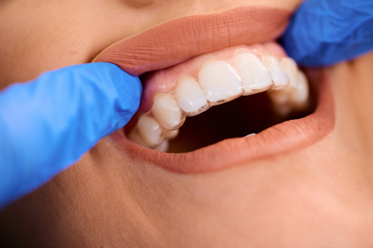 Invisalign aligners used to improve bite alignment and reduce tmj related discomfort