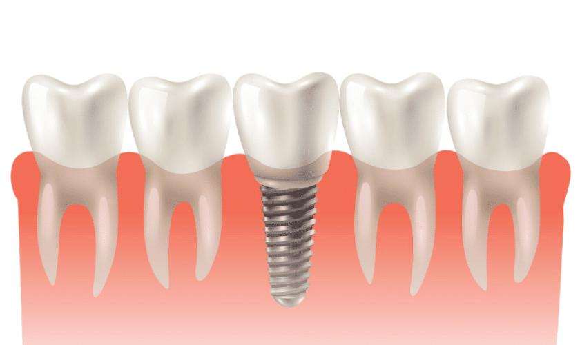 Benefits of Choosing Dental Implants Over Dentures