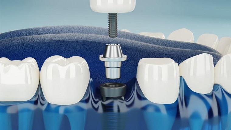 Dental Implant upland