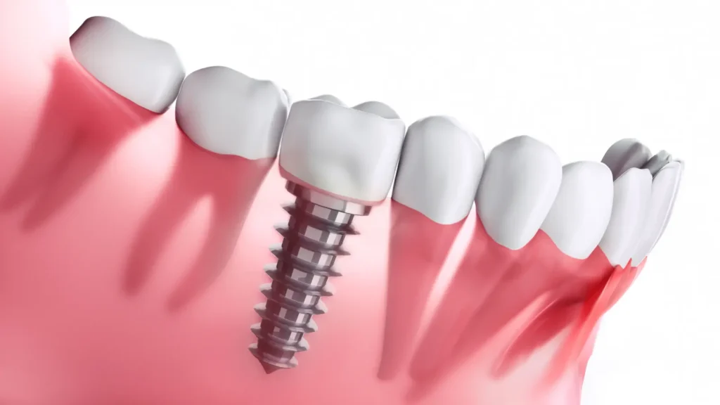 parts of a dental implant and how it integrates with the jawbone