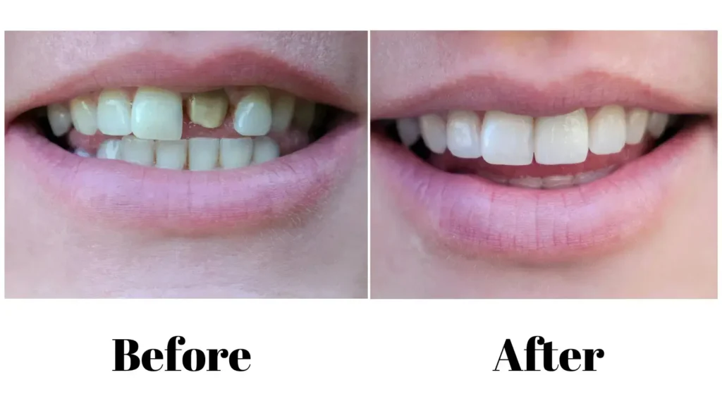 diagram of a part of a dental implant and how it integrates with the jawbone
