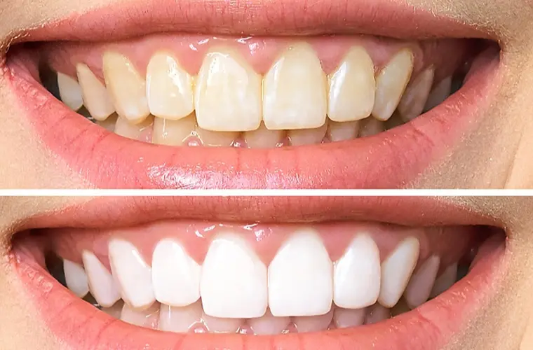 Teeth Whitening Upland, CA