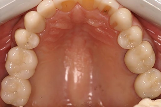 after smile makeover upland dentist