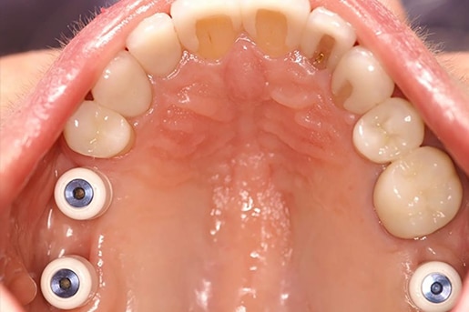 before smile transformation upland dentist