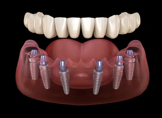 img-all-on-x-implants