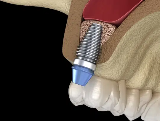 img-bone-sinus-grafting