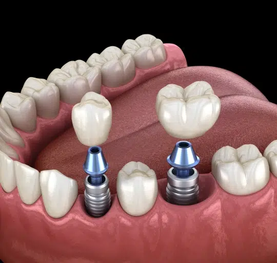 img-dental-implants-consultation-Benefits-of-Dental-Implants