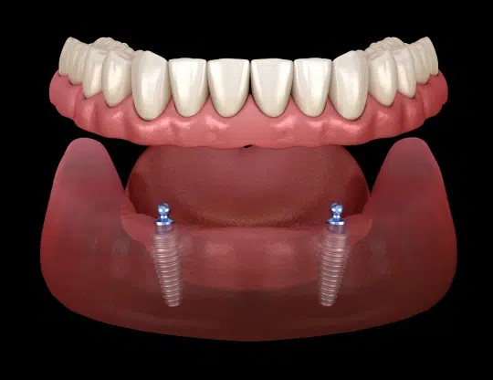 img-implant-placement