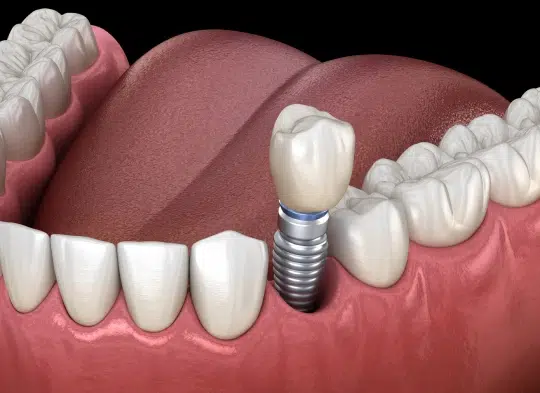 img-single-tooth-implant