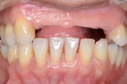 Close up view of missing upper front teeth before